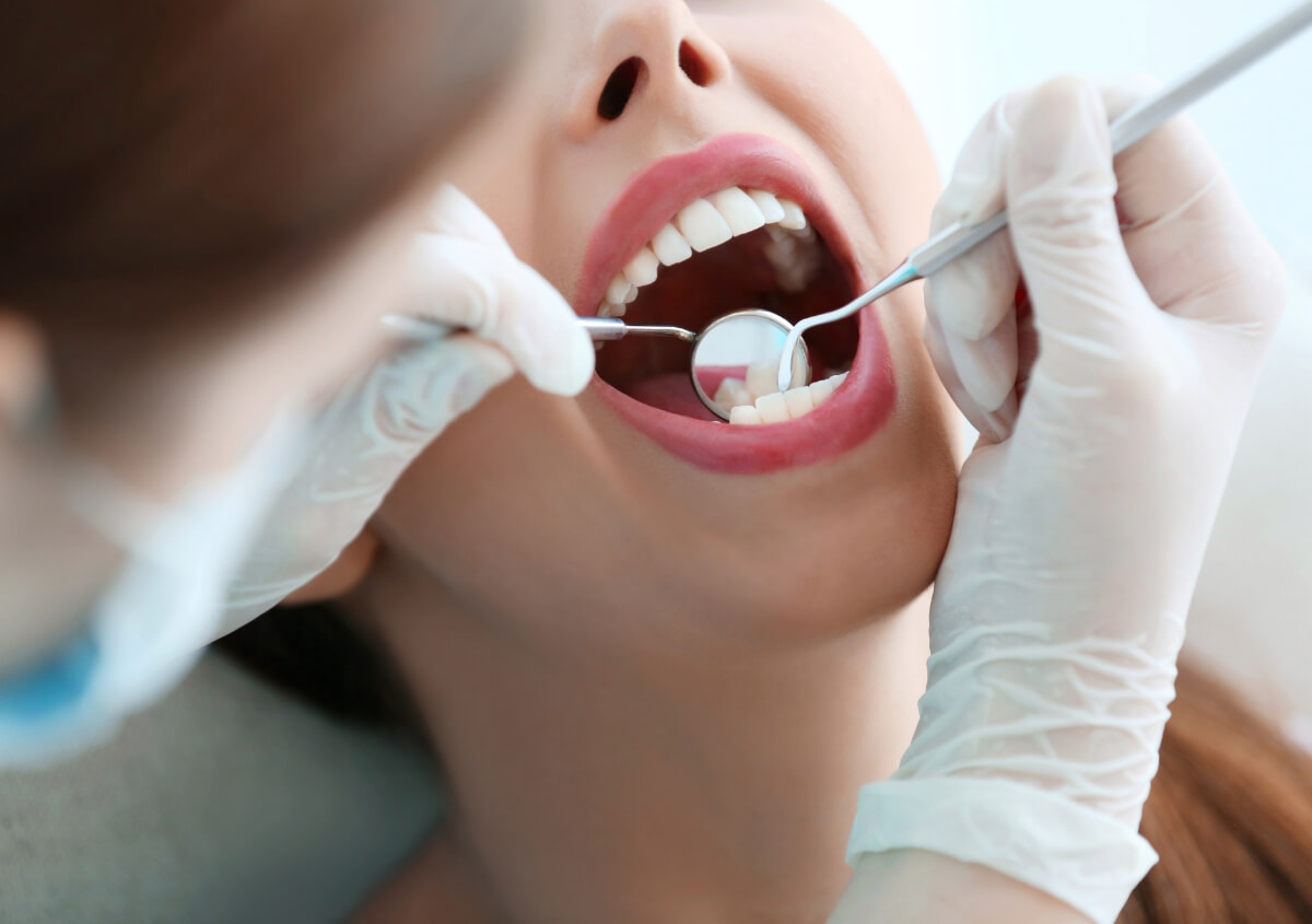 White Cavity Fillings in Los Angeles CA area